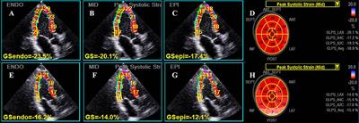 Does Masked Hypertension Cause Early Left Ventricular Impairment in Youth?